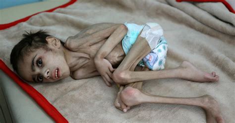 Yemeni Boy Ravaged By Hunger Weighs 7 Kg Reuters