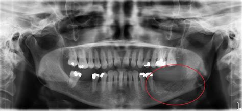 Osteomyelitis Jaw After Wisdom Teeth Extraction