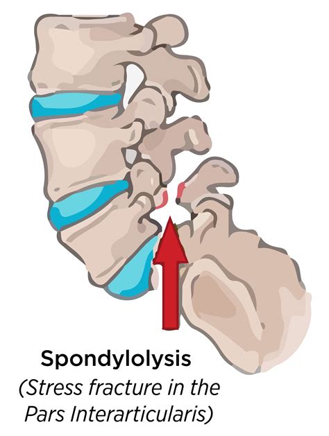 Spondylolysis Of The Lumbar Spine Symptoms Causes And Treatments