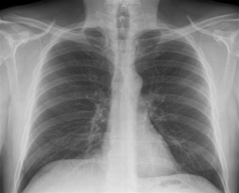Normal Chest X Ray Pa View Female