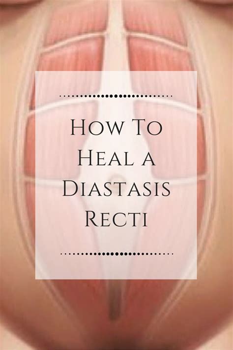 diastasis recti abdominal separation during and after