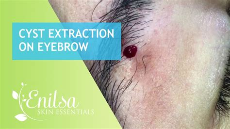 Cyst Extraction On Eyebrow Youtube