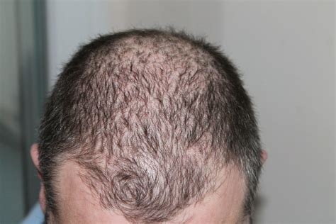 Male Pattern Baldness Mpb With Causes And How To Deal With It Gethair