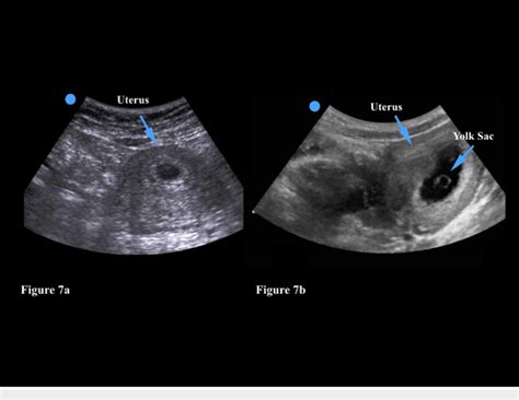 A An Empty Gestational Sac Within A Uterus May Signify A Very Early