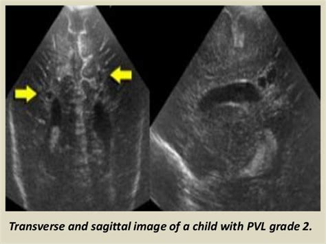 Presentation1pptx Ultrasound Examination Of The Neonatal Head
