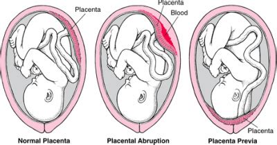Historically, there have been three defined types of placenta previa: Ob 6 at Johns Hopkins University School of Medicine ...