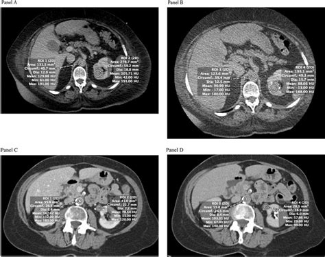 A A Contrast Enhanced Ct Scan Of A Patient With A Left Renal Mass Is