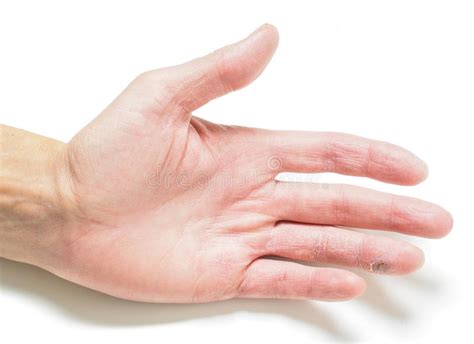 Finger With Infected Cut On Hand With Dry Skin Stock Photo Image Of