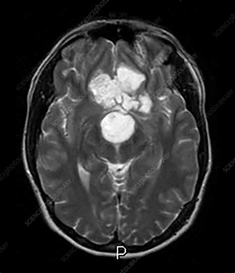 Intracranial Dermoid Cyst On Mri Stock Image C0432993 Science
