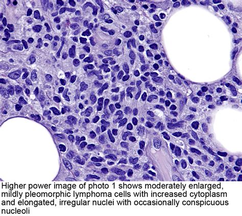 Pathology Outlines Primary Cutaneous Gamma Delta
