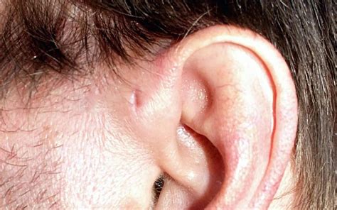 Flipboard Hole In Ear Preauricular Pit What To Know