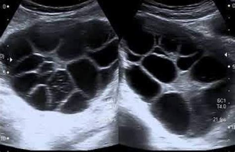 Ovaries Hormonal Cycles And Common Cysts Ultrasoundfeminsider