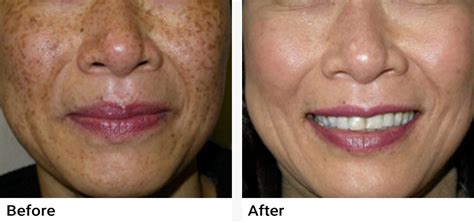 Ipl Photofacial Correct Skin Damage Reduce Discoloration
