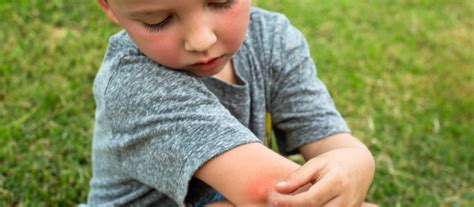 Allergic Reactions To Mosquito Bites Pediatrix