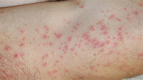 Válasz Visszaesik Szemben Red Spots On Skin Not Itchy Lusta Hamisítvány