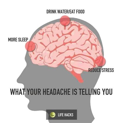 19 Luxury Headache Location Chart And Meaning