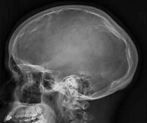 Plastic Surgery Case Study Bony Reduction Of The Congenital Occipital