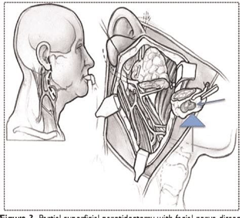Figure 1 From Extracapsular Dissection With Facial Nerve Dissection For