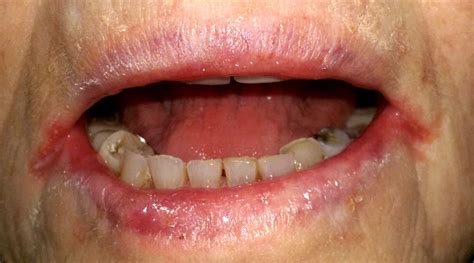 Natural Remedies For Angular Cheilitis Dental News