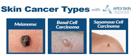 Common Types Of Skin Cancer