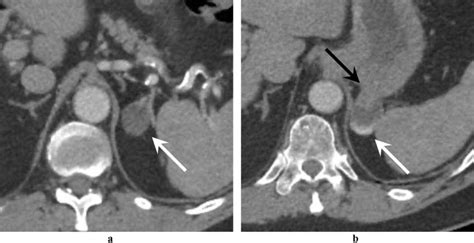 An Example Of Gastric Diverticulum Mimicking An Adrenal Nodule In A