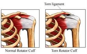 Rotator Cuff Injury Specialist Singapore Sports And Orthopaedic Clinic Neurosurgeon