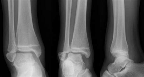 Case 2 Anteroposterior Mortise And Lateral Radiographic Views Of The