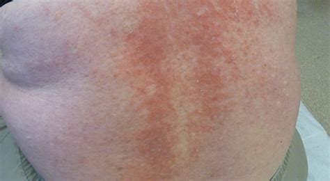 Eczema On The Back
