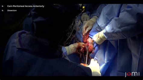 Vaginal Hysterectomy Uterosacral Ligament Suspension And Excision Of