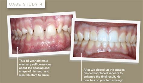 Lingual Braces For Overbite At South Qld 4215 By Gullottaorthodontics
