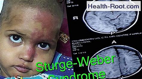 Sturge Weber Syndrom 🏥 Krankheit Symptome Behandlung 2023
