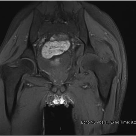 Mri Of The Left Hip Demonstrating Synovial Thickening Blue And