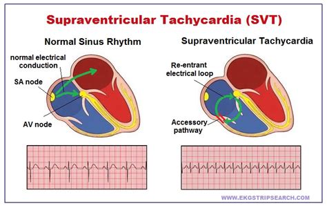 Ekg Strip Search Supraventricular Tachycardia Svt Svt Svt Heart Hot