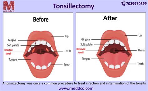 tonsillectomy intonsillectomy recovery