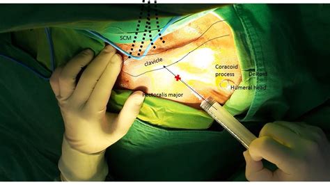 Implanted Venous Access Device Port A Implantation Left Subclavian