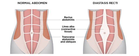 Diastasis Recti Treatment In Jersey City Nj Liberty Physical Therapy