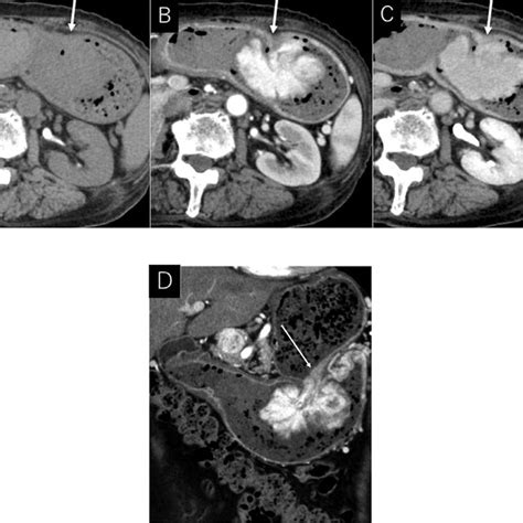 Dynamic Contrast Enhanced Computed Tomography Ct Scans A