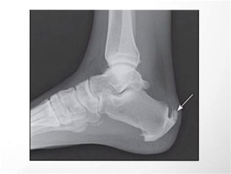 Haglunds Deformity And Other Causes Of Heel Pain In Runners Irunfar