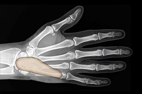 Infection Flexor Tendon Sheath Hand Surgery Source