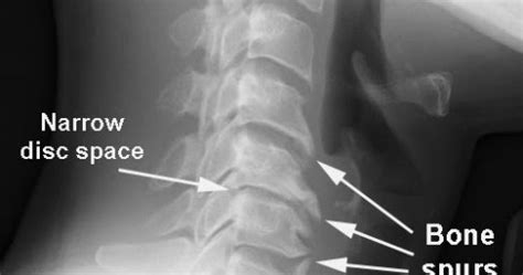Cervical osteoarthritis can be treated in early and proper diagnosis is necessary for treatment of cervical spondylosis/cervical osteoarthritis. Study Medical Photos: A Case Of Cervical Spondylosis