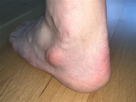 Why Do I Have An Extra Bump Below The Ankle Joint Podiatry