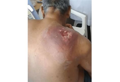 Very Large Infection On The Back Of The Shoulder Boils On Buttocks