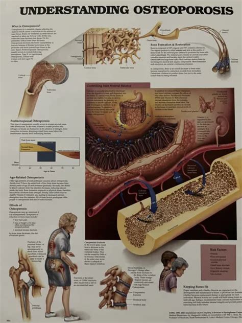 Anatomical Chart Understanding Osteoporosis Anatomy Poster 1125 X