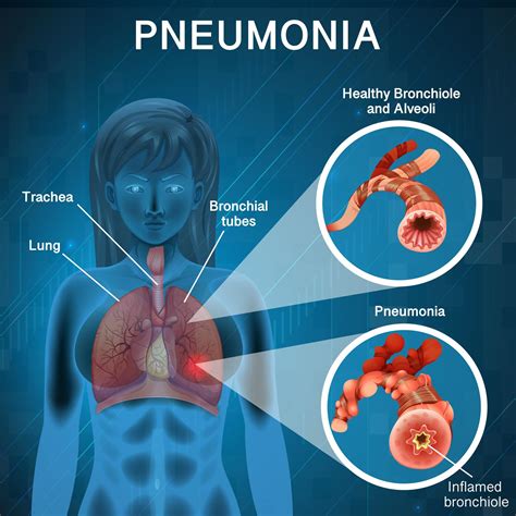 Pneumonia With Human Lungs Diagram 1214691 Vector Art At Vecteezy
