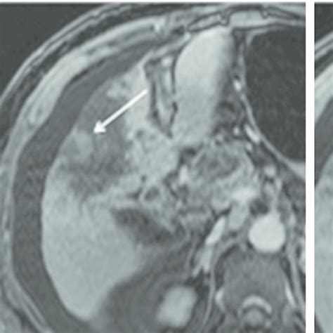 Testicular Mesothelioma In A 53 Year Old Man Ct Image Shows An Omental