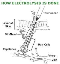 We did the research so you don't have to, and found the top. Pin on electrology/electrolysis