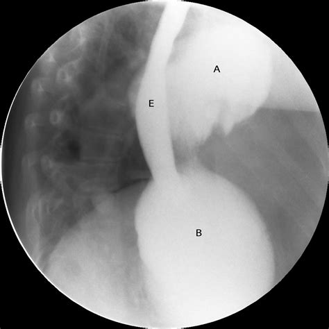 “a Large Hiatal Hernia” Atypical Presentation Of Gastric Volvulus
