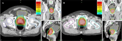 Salvage Helical Tomotherapy For Prostate Cancer Recurrence Following Definitive External Beam