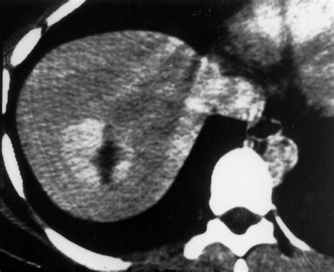 Imaging Of Atypical Hemangiomas Of The Liver With Pathologic