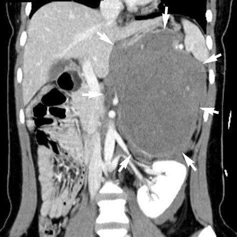 Coronal Contrast Enhanced Ct Image Shows A Large Left Suprarenal